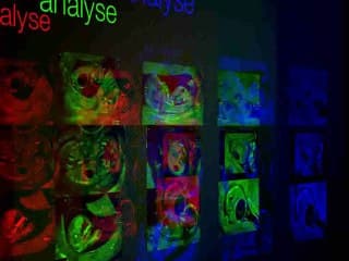 1er trimestre Images liquidiennes intra-abdominales