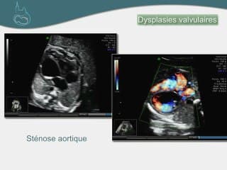 Cardiopathie de revelation tardive