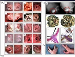 Constat chirurgical versus diagnostic échographique