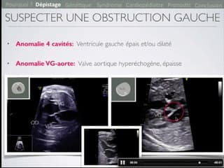 Coeur : ECHOGRAPHIE Quand, comment, pourquoi examiner les valves cardiaques ?