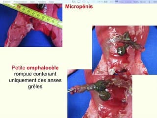 Ostéopathie striée avec sclérose de la base du crâne : quand un syndrome malformatif foetal révèle la pathologie maternelle