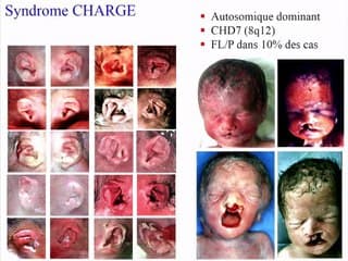 Fentes labio-palatines et vélo-palatines, rétrognatisme › Génétique : quel examen, pour qui ?