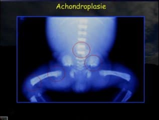Achondroplasie