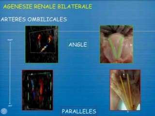 L'appareil urinaire au 1er trimestre : ne pas oublier la loge rénale et ses nouveaux signes.