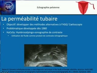 L’écho et la perméabilité tubaire : quand l’écho prend la suite de l’hystérosalpinpographie et complète le bilan d’infertilité