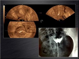 Imagerie :l'hystérosalpingosonographiede constraste (HyCoSy) : finde l'hystérosalpingographieradiologique ?