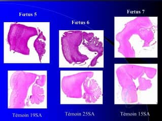 Confrontations foetopathologiques : en sous tentoriel : confrontations écho-IRM et fœtopath