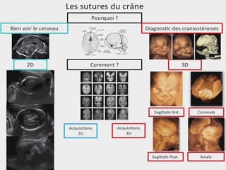 POSTER Sutures du Crâne