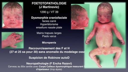 Syndome d'Aarskog scott facio-digito-génital