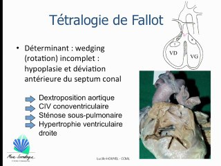 TGV et anomalie des gros vaisseaux embryologie