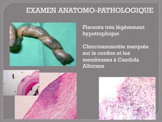 Quand la physiologie de la grossesse devient une situation à risque