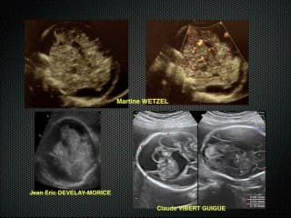 Tumeurs cérébrales foetales : Etude des 46 cas colligés par le CFEF