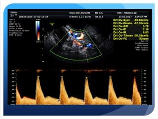 Intérêt à mesurer les Dopplers chez la femme infertile