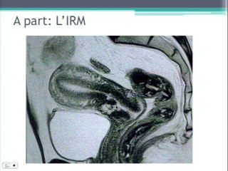 Technique et intér't del'analyse des cicatrices de césarienne avant une grossesse : Le point de vue du chirurgien