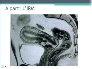 Technique et intér't del'analyse des cicatrices de césarienne avant une grossesse : Le point de vue du chirurgien