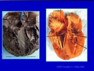 Trisomie 12 q partielle