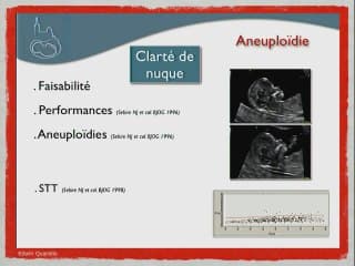 MISE AU POINT SUR LES GROSSESSES GÉMELLAIRES. POURQUOI UN SUIVI À LA CARTE ? Importance du diagnostic du premier trimestre