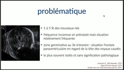 Quel bilan pour les kystes paraventriculaires de diagnostic prénatal ?