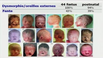 Le syndrome de CHARGE Génétique et foetopathologie.