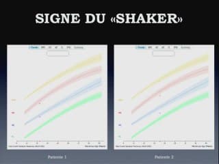 Le signe du SHAKER :Un aspect inhabituel du placenta