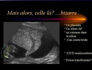 De quelle bride parlez vous ?