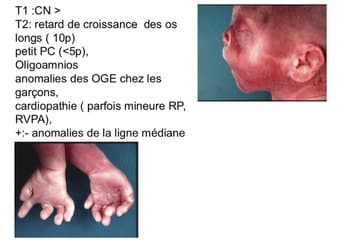 retard de croissance intra utérin : bilan des rciu non vasculaires : quelles investigations ?