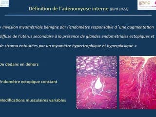 Imagerie de l’adénomyose : peut-on se passer de l’IRM ?