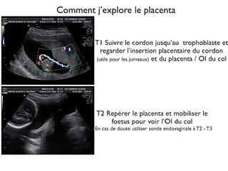 POSTER Placenta LA