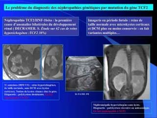 Apport de l’IRM dans la pathologie rénale foetale