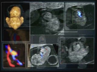 échographie  du coeur au 1 er trim