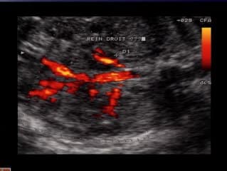 Trisomie 16 en mosaique