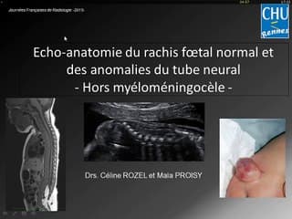 Echo-anatomie du normal et des anomalies du tube neural, hors myéloméningocèle (mmc)