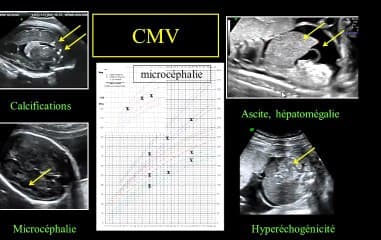 Quelle évaluation échographique étiologique du RCIU ? (échographie « diagnostique »)