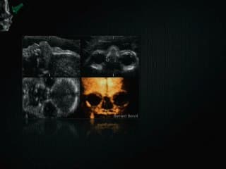 Pièges et artéfacts du dépistage : Faux positifs et Faux négatifs