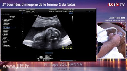 Le cou (thyroïde, trachée, œsophage, oropharynx, thymus) live