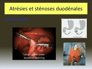 Atrésies intestinales : quoi de neuf ?