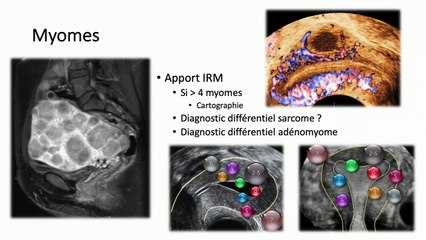 Place de la sonographie en cas de fibrome