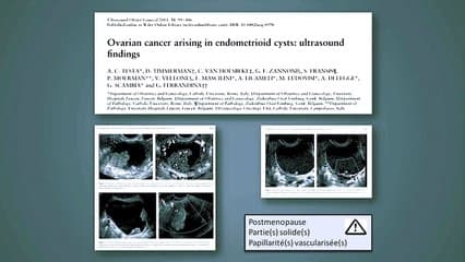 Imagerie et endométrioses : pour qui et pourquoi ?
