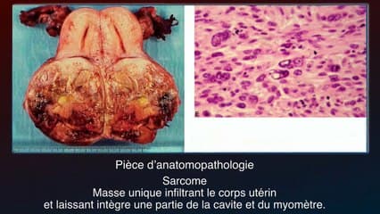 Approche échographique du sarcome