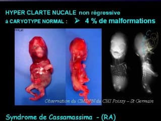 Hyperclarté à caryotype normal : devenir et élément de pronostic