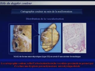 Le Doppler couleur dans les malformations pulmonaires.