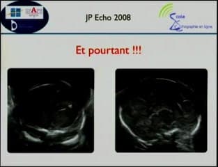 Pièges et artéfacts, variants de la normale : comment s’en sortir...?