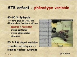Imagerie et pronostic de la sclérose tubéreuse de Bourneville.