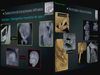 échographie des membres inférieurs