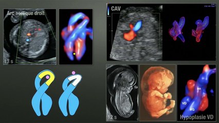 Dépistage des anomalies chromosomiques et des anomalies associées I) Choix et stratégies › Les nuques