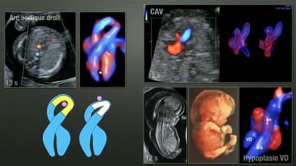 Dépistage des anomalies chromosomiques et des anomalies associées I) Choix et stratégies › Les nuques