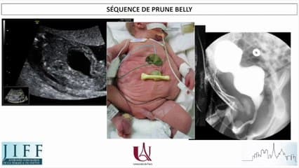 REINS, VOIES URINAIRES, : Bibliographie :Megavessie