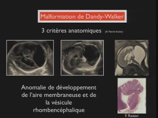 Orientation diagnostique devant une anomalie échographique de la fosse postérieure