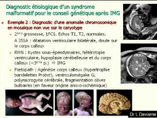 CGH et diagnostic prenatal. Le point de vue du généticien liquidien