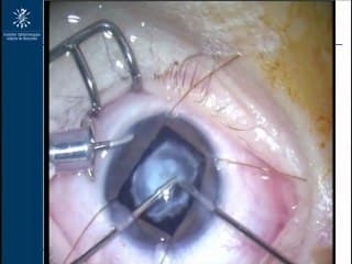 Persistance de la vascularisation foetale